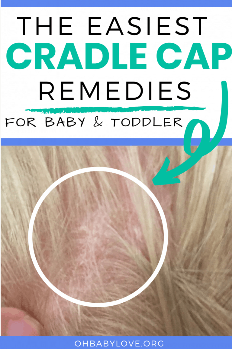 Cradle Cap Home Remedies to Get Rid of It! Oh Baby Love
